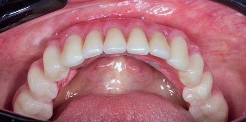 All-on-4 имплантация после