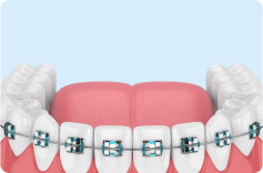 Исправление прикуса