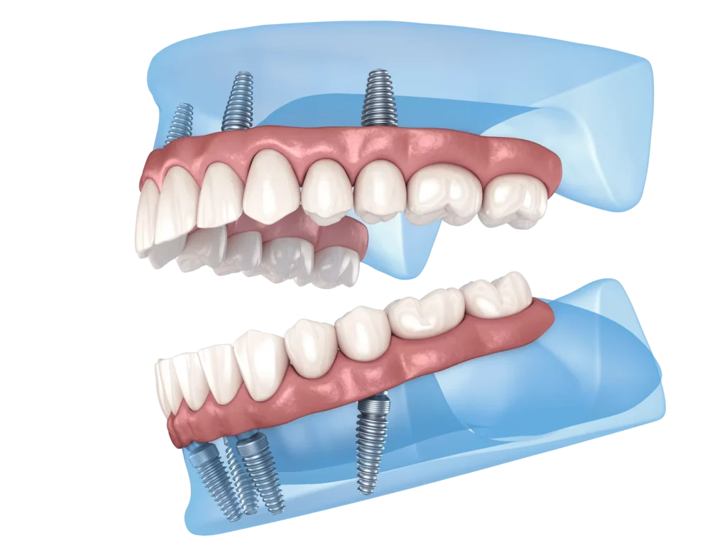 all-on-4 имплантация