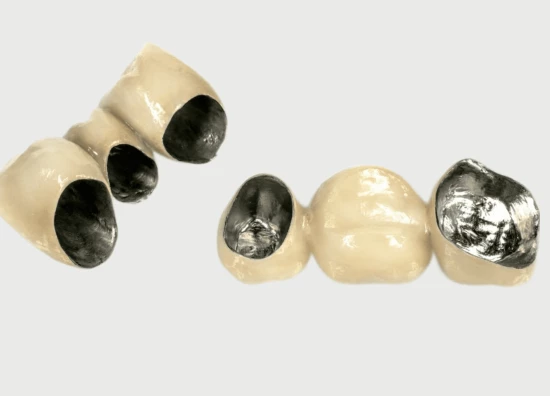 металлокерамические коронки