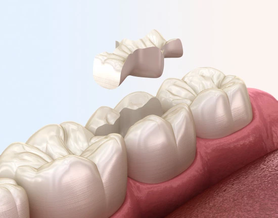 Зубные вкладки