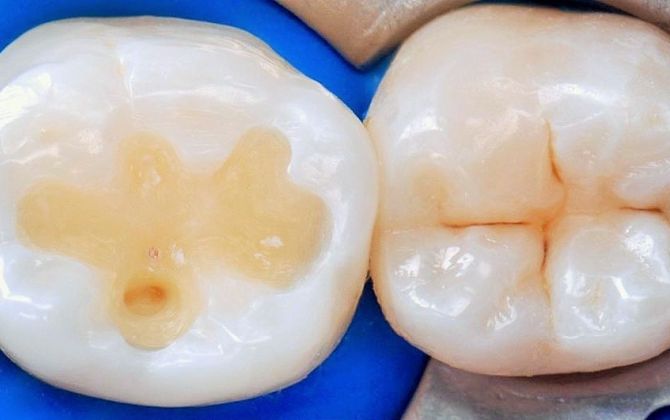 Лечение зубов до