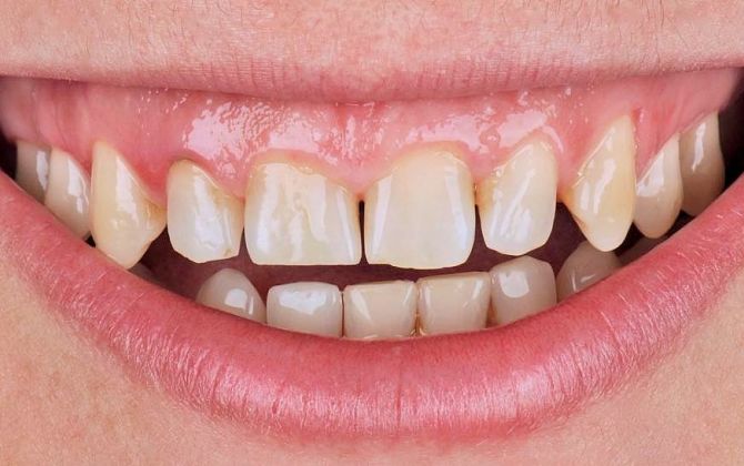 Установка виниров E-Max до